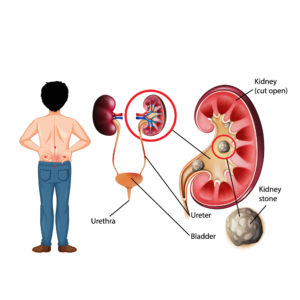 kidney stones formation